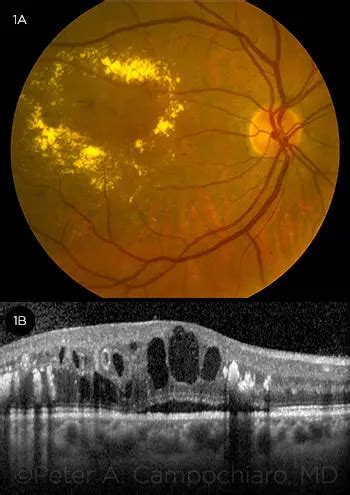 Diabetic Macular Edema—Personalizing Treatment - American Academy of Ophthalmology