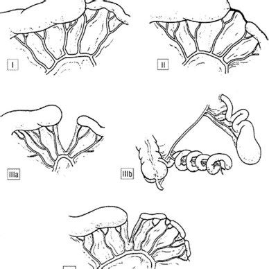 Patient's abdomen was quite distended on exam with visible dilated... | Download Scientific Diagram