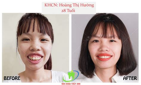 Niềng răng có làm bớt răng hô môi dày đi không? Nha khoa Thùy Anh - nhakhoathuyanh