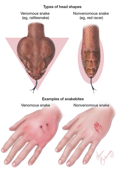 Snakebite | Dermatology | JAMA | JAMA Network