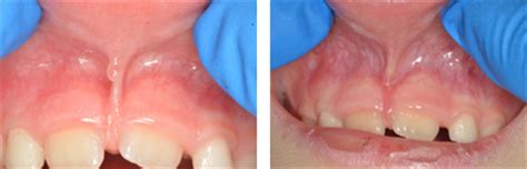 Before and after Periodontist Beverly Hills | Real Patient images ...