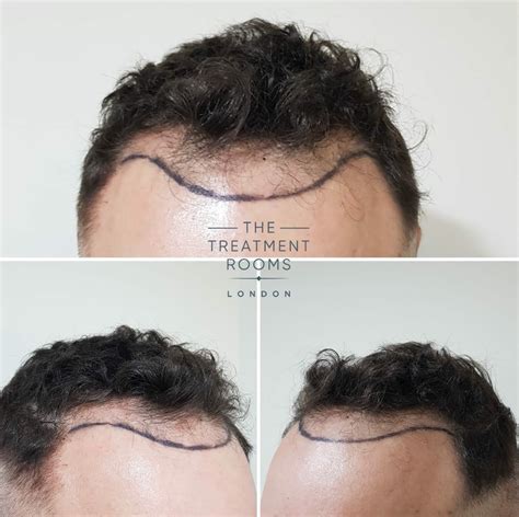 Mature Hairline Vs Receding Hairline | Treatment Rooms London