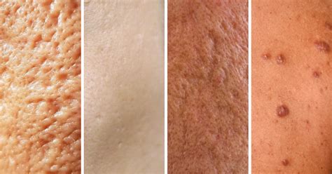 Types of acne scars and how we can help - Melior Clinics