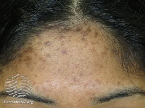 Post-Inflammatory Hyperpigmentation: Causes and Treatments