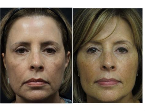 Before and After Photos - Central Florida Dermatology Associates