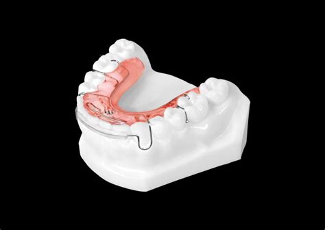 Standard Spring Retainer (Lower) - Universal Orthodontic Lab