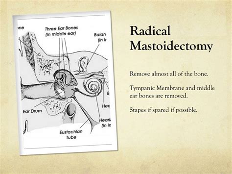 PPT - Mastoidectomy PowerPoint Presentation, free download - ID:2691521