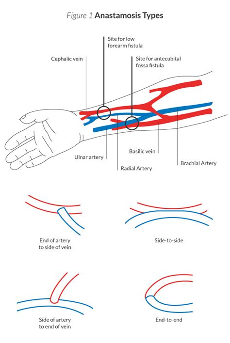 laminate-blog-illus_types-of-anastomosis