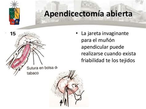 Apendicectomía abierta y vlp