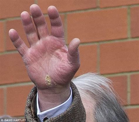 Prince Charles reveals cracked and tired looking hand | Daily Mail Online