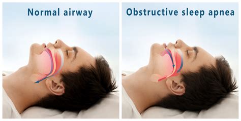 What are My Surgical Options for Sleep Apnea?