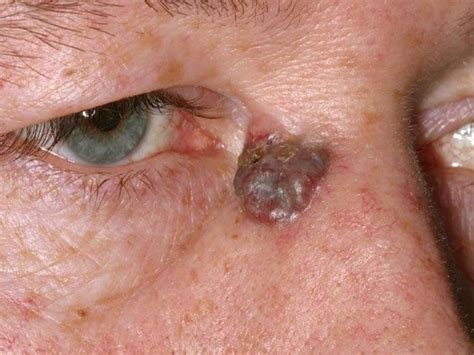 Basal Cell Carcinoma - Symptoms, Types and Pictures