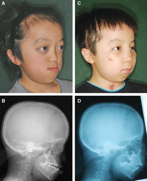 Patient 1: A 12-year-old male patient with Crouzon syndrome. A,... | Download Scientific Diagram