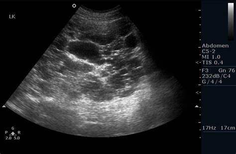 Polycystic Kidney Disease Ultrasound