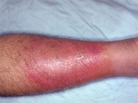 Cellulitis Symptoms