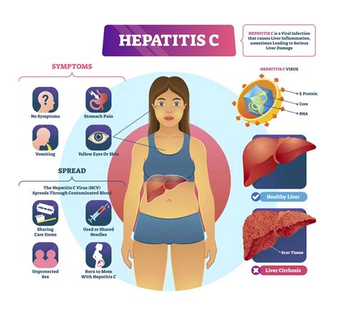 Hepatitis C Liver Disease