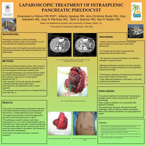 Laparoscopic Treatment of Intrasplenic Pancreatic Pseudocyst - SAGES Abstract Archives