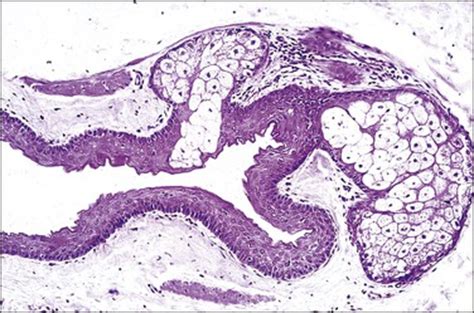 Steatocystoma Multiplex Histology