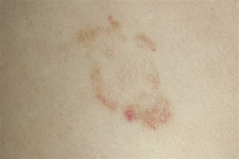 The Healing Stages of Ringworm (with Pictures)