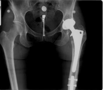 Anterioposterior radiograph of original left total hip arthroplasty... | Download Scientific Diagram