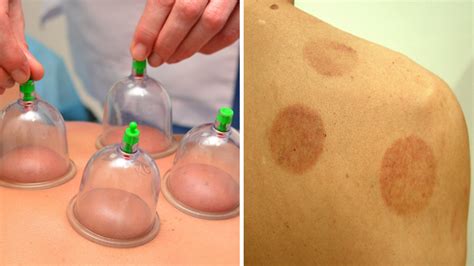 What Is Cupping Treatment? Man Left With Bruises After Cupping | Allure