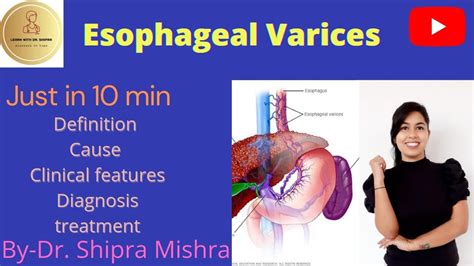 Esophageal Varices In Hindi Cause Symptoms Diagnosis Treatment Dr | Hot ...