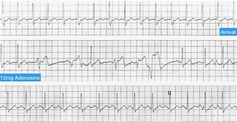 Supraventricular Tachycardia (SVT) • LITFL • ECG Library Diagnosis