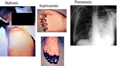 Yersinia pestis bacteria transmission, symptoms, diagnosis and treatment