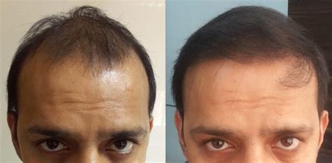 Biofibre Hair Transplant India - Cost and Process Involved - Prime Hair ...