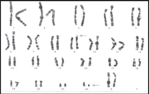 Figure 2 from Inherited t(9;22) as the cause of DiGeorge syndrome: a ...