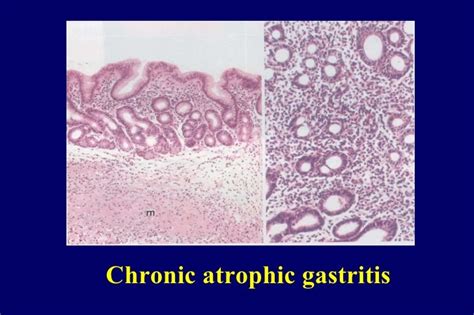 17 chronic gastritis gao