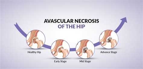 Avascular necrosis of the hip