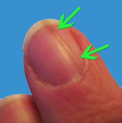 Line on nails vitamin deficiency - Awesome Nail