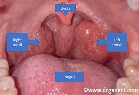 How to Get Rid of Tonsil Stones - Tonsil Stone Removal vs Tonsillectomy