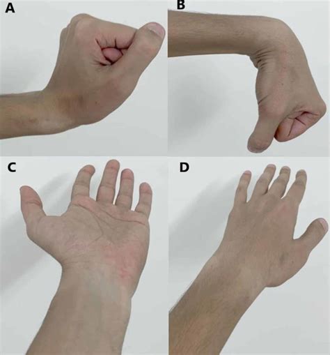 Cureus | Volar Radiocarpal Dislocation: A Case Report and Review of Literature