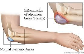 Elbow Bursitis Treatment - Denver's Best | 5280 Cryo & Recovery Clinic