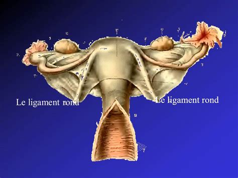 Uterine Rupture