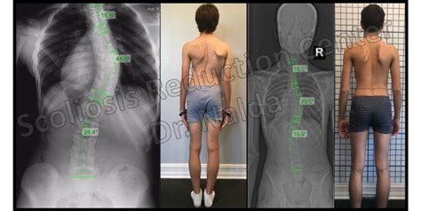 Scoliosis Treatment Results - See Before and After Pictures