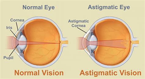 All About Astigmatism | Zenni Optical