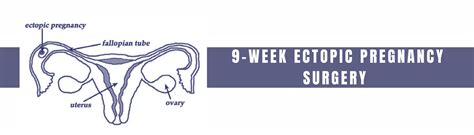 9-Week Ectopic Pregnancy Surgery - Causes and Treatment