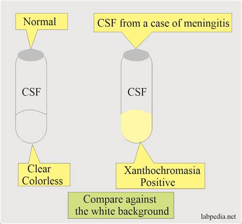 Cerebrospinal fluid Xanthochromia (CSF) - Labpedia.net