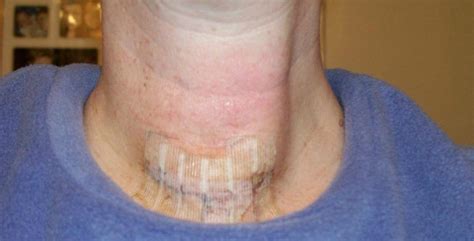 thyroid surgery scar - Next Could News