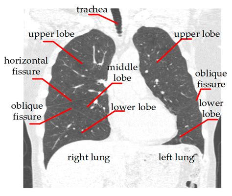 Algorithms | Free Full-Text | Lung Lobe Segmentation Based on Lung Fissure Surface ...