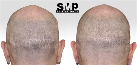 hair tattoo before and after Toronto | The Original SMP® Scalp Micropigmentation Hair Tattoo Clinic