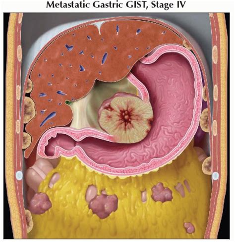 Gastrointestinal Stromal Tumor (GIST) | Radiology Key