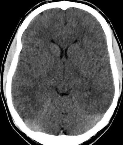 FULL TEXT -What’s with all the water? Diuretic use for cerebral edema due to ecstasy ...