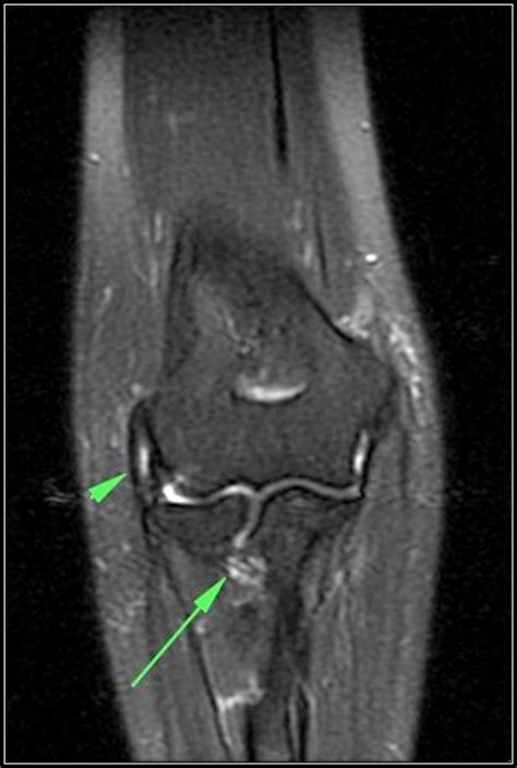 Figure 1. Coronal T2 fast spin-echo weighted fat-suppressed MRI of the ...