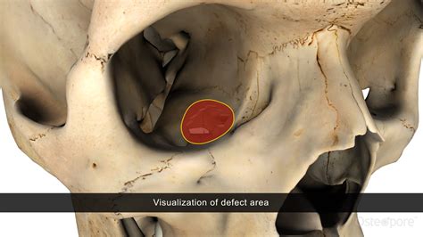 Orbital Floor Reconstruction | Osteopore