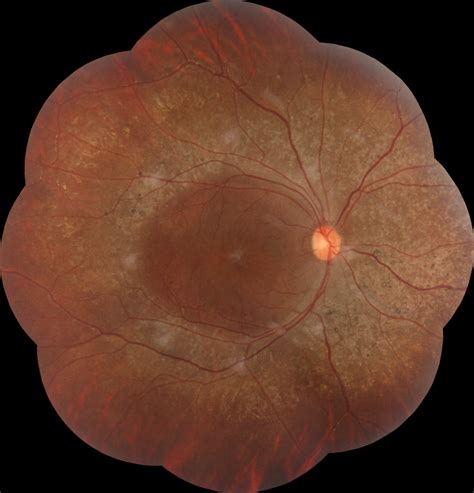 Retinitis Pigmentosa (RP) - Dr Rehman Siddiqui