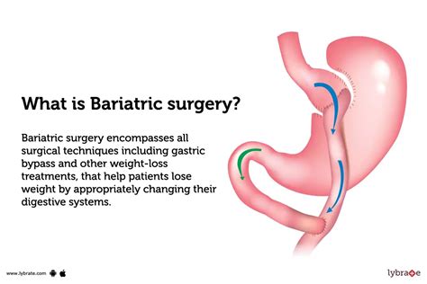 Bariatric Surgery: Purpose, Procedure, Benefits and Side Effects